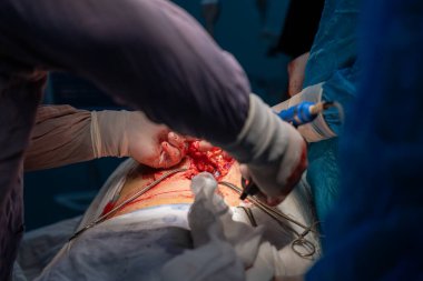 Bir grup cerrah bir hastaya ameliyat yapıyor. Cerrahlar görevlerine odaklandığı için sahne yoğun ve ciddi. Hasta masanın üzerinde yatıyor.