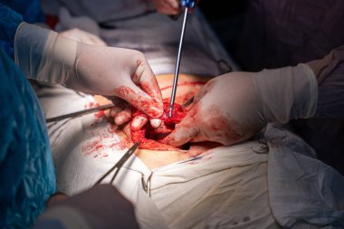 Bir cerrah bir hastanın midesini kesiyor. Hastanın kanaması var ve cerrah karnını kesmek için neşter kullanıyor.