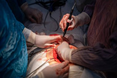 Bir cerrah bir hastanın midesini kesiyor. Cerrah bir neşter kullanarak kesik attığı için sahne yoğun ve dramatik. Diğer cerrahlar yakından izliyor.