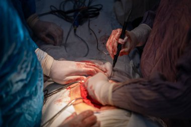 Bir cerrah bir hastanın midesini kesiyor. Cerrahlar hastanın hayatını kurtarmak için çalışırken sahne yoğun ve dramatik. Parlak ışıkların kullanımı