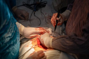 Bir cerrah bir hastanın midesini kesiyor. Hastanın kanaması var ve cerrah midesini kesmek için neşter kullanıyor.