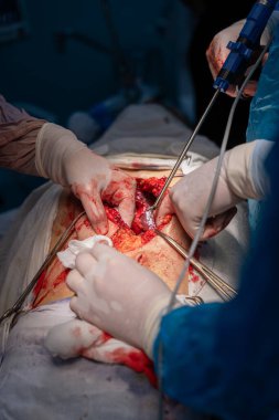 Bir cerrah bir hastanın midesini kesiyor. Hastanın kanaması var ve cerrah midesini kesmek için neşter kullanıyor.