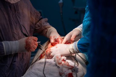 Bir cerrah bir hastanın midesini kesiyor. Olay yeri kanlı ve yoğun. Cerrahlar kendilerini kandan ve diğer vücut sıvılarından korumak için eldiven ve maske takıyorlar.