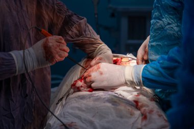 Bir cerrah bir hastanın midesini kesiyor. Hastanın kanaması var ve cerrah eldiven giyiyor.