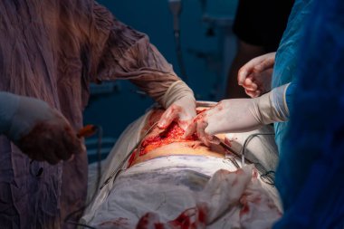 Bir grup cerrah bir hastaya ameliyat yapıyor. Cerrahlar hastanın hayatını kurtarmak için çalışırken sahne yoğun ve dramatik.