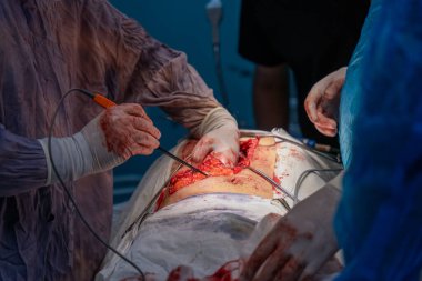 Bir cerrah bir hastanın midesini kesiyor. Hastanın kanaması var ve cerrah kanamayı durdurmaya çalışıyor.