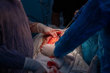 Bir cerrah bir hastanın midesini kesiyor. Hastanın kanaması var ve cerrah kanamayı durdurmaya çalışıyor.