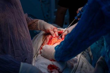 Bir cerrah bir hastanın midesini kesiyor. Cerrah hayat kurtaran bir prosedür uygularken sahne yoğun ve dramatik. Hastanın durumu kritik.