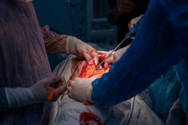 Bir cerrah bir hastanın midesini kesiyor. Cerrah hayat kurtaran bir prosedür uygularken sahne yoğun ve dramatik.