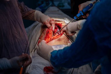 Bir cerrah bir hastanın midesini kesiyor. Cerrah ve diğer tıp uzmanları hastanın hayatını kurtarmak için çalışırken sahne yoğun ve dramatik.