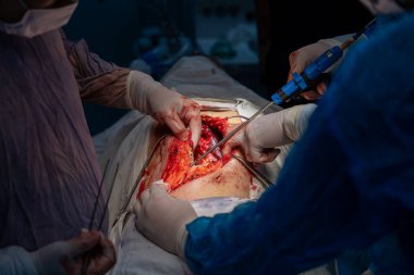 Bir cerrah bir hastanın midesini kesiyor. Hastanın kanaması var ve cerrah midesini kesmek için neşter kullanıyor.