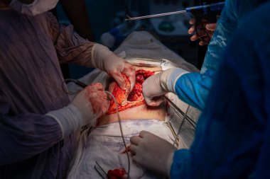 Bir grup cerrah bir hastaya ameliyat yapıyor. Cerrahlar görevlerine odaklandığı için sahne yoğun ve ciddi. Hasta bir hastane yatağında.