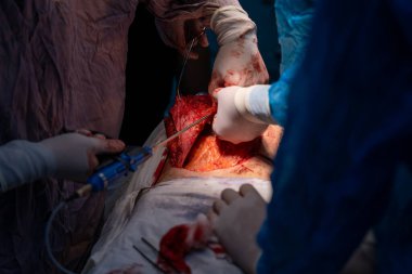 Bir grup cerrah bir hastaya ameliyat yapıyor. Cerrahlar hastanın hayatını kurtarmak için çalışırken sahne yoğun ve dramatik. Atmosfer gergin ve odaklanmış.