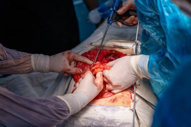 Bir grup cerrah bir hastaya ameliyat yapıyor. Cerrahlar görevlerine odaklandığı için sahne yoğun ve ciddi. Hastanın durumu kritik.