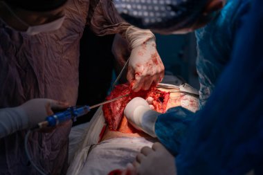 Bir cerrah bir hastanın vücudunu kesiyor. Cerrahlar hastanın hayatını kurtarmak için çalışırken sahne yoğun ve dramatik.