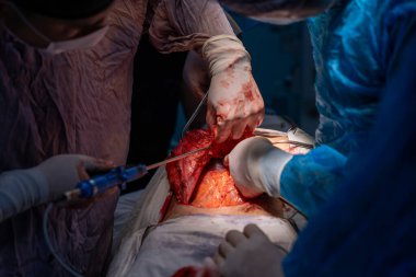 Bir grup cerrah bir hastaya ameliyat yapıyor. Cerrahlar hastanın hayatını kurtarmak için çalışırken atmosfer gergin ve ciddi.