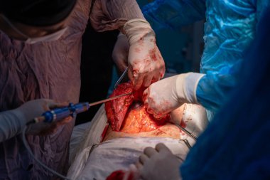 Bir cerrah bir hastanın midesini kesiyor. Cerrahlar hastanın hayatını kurtarmak için çalışırken sahne yoğun ve dramatik.