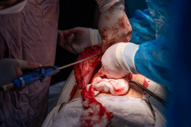 Bir cerrah bir insanın karnını deşiyor. Olay yeri kanlı ve yoğun. Cerrah eldiven ve maske takıyor ve odada başka insanlar da var.