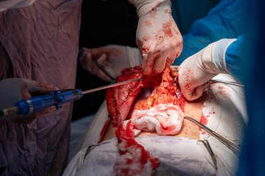 Bir cerrah bir hastanın vücudunu kesiyor. Cerrah hastanın hayatını kurtarmak için çalışırken sahne yoğun ve dramatik. Odadaki diğer insanlar muhtemelen hemşireler ya da diğer sağlık görevlileri.