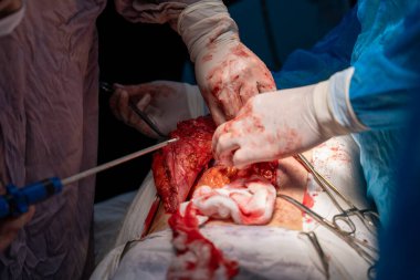 Bir cerrah bir hastanın midesini kesiyor. Olay yeri kanlı ve yoğun, cerrah eldiven ve maske takıyor. Hasta büyük ihtimalle büyük bir ameliyat geçiriyor.