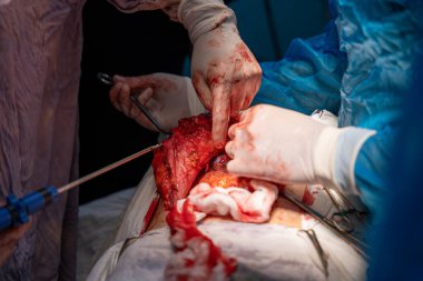 Bir cerrah bir insanın karnını deşiyor. Olay yeri kanlı ve yoğun. Cerrah eldiven ve mavi bir ameliyat elbisesi giyiyor.