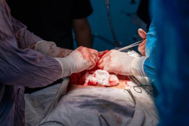 Bir cerrah bir hastanın midesini kesiyor. Olay yeri kanlı ve yoğun. Cerrah eldiven ve mavi bir ameliyat elbisesi giyiyor.