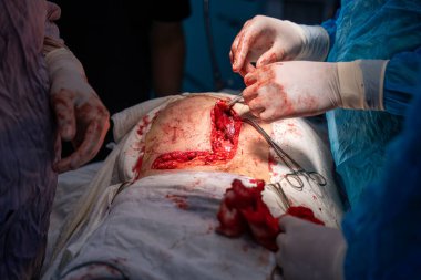 Bir cerrah bir hastanın midesini kesiyor. Hastanın kanaması var ve cerrah mideyi açmak için neşter kullanıyor. Sahne yoğun ve dramatik.