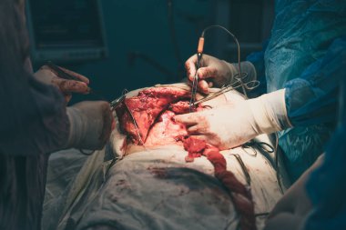 Bir grup cerrah bir hastaya ameliyat yapıyor. Cerrahlar hastanın vücudunu kesmek için keskin aletler kullandıkları için sahne yoğun ve dramatik.