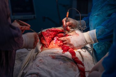 Bir grup cerrah bir hastaya ameliyat yapıyor. Cerrahlar hastanın vücudunu keserken sahne yoğun ve dramatik. Hasta çok acı çekiyor.