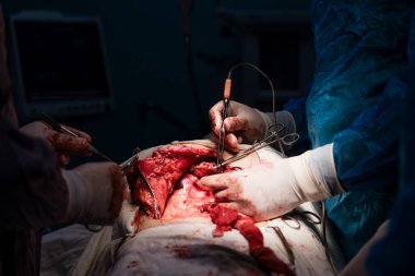 Bir cerrah bir hastanın midesini kesiyor. Olay yeri kanlı ve yoğun. Cerrahlar eldiven ve maske takıyor ve yakınlarda bir monitör var. Hasta bir hastane yatağında.