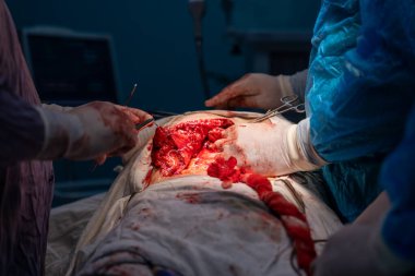 Bir cerrah bir hastanın midesini kesiyor. Olay yeri kanlı ve yoğun. Cerrahlar eldiven ve maske takıyor ve hasta hastane yatağında yatıyor.