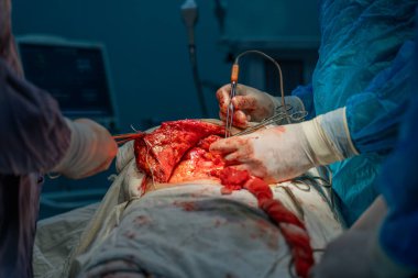 Bir cerrah bir hastanın midesini kesiyor. Olay yeri kanlı ve yoğun. Cerrahlar eldiven ve maske takıyor ve hasta masanın üstünde.