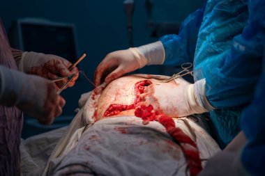 Bir cerrah bir hastanın midesini kesiyor. Hastanın kanaması var ve cerrah kanamayı durdurmaya çalışıyor. Sahne yoğun ve dramatik.