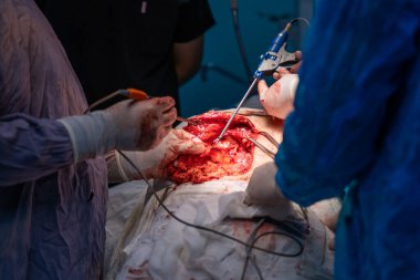 Bir cerrah bir hastanın midesini kesiyor. Hastanın kanaması var ve cerrah mideyi açmak için neşter kullanıyor. Sahne yoğun ve dramatik.