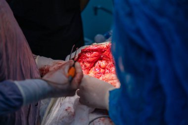 Bir cerrah bir hastanın midesini kesiyor. Hastanın kanaması var ve cerrah karnını kesmek için neşter kullanıyor.