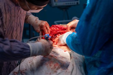 Bir cerrah bir hastanın vücudunu kesiyor. Cerrahların ameliyat eldiveni ve maskesi taktığı sahne yoğun ve dramatik. Hasta masanın üzerinde yatıyor.