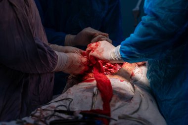 Bir grup cerrah bir hastaya ameliyat yapıyor. Cerrahlar görevlerine odaklandığı için sahne yoğun ve ciddi. Hasta masanın üzerinde yatıyor.