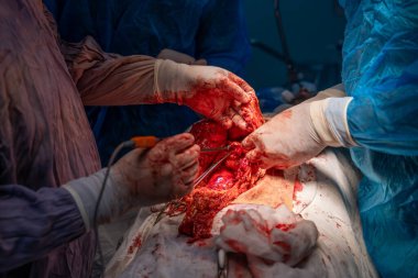 Bir grup cerrah bir hastaya ameliyat yapıyor. Olay yeri yoğun ve dramatik. Cerrahlar hastanın vücudunu kesmek için keskin aletler kullanıyor. Atmosfer ciddi.