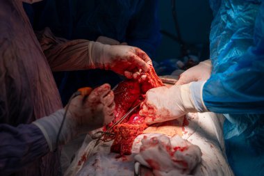 Bir grup cerrah bir hastaya ameliyat yapıyor. Olay yeri yoğun ve dramatik. Cerrahlar hastanın vücudunu kesmek için keskin aletler kullanıyor. Atmosfer ciddi.