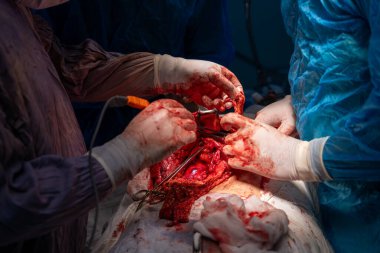 Bir grup cerrah bir hastaya ameliyat yapıyor. Olay yeri yoğun ve dramatik. Cerrahlar hastanın hayatını kurtarmak için birlikte çalışıyorlar.