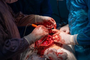 Bir grup cerrah bir hastaya ameliyat yapıyor. Cerrahlar hastanın vücudunu keserken sahne yoğun ve dramatik. Atmosfer ciddi ve odaklı.