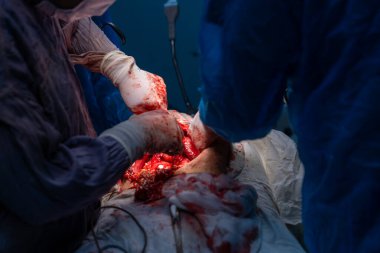 Bir cerrah bir hastanın vücudunu kesiyor. Cerrah hayat kurtaran bir prosedür uygularken sahne yoğun ve dramatik. Hastanın hayatı cerrahın ellerinde.