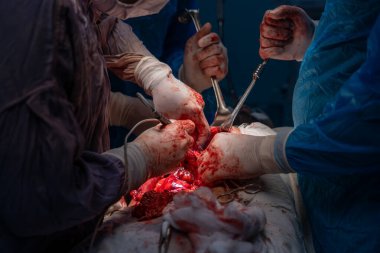 Bir grup cerrah bir hastaya ameliyat yapıyor. Cerrahlar hastanın vücudunu kesmek için keskin aletler kullandıkları için sahne yoğun ve dramatik. Kanın kırmızı rengi.