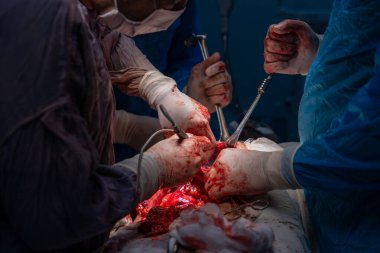 Bir grup cerrah bir hastaya ameliyat yapıyor. Cerrahlar hastanın hayatını kurtarmak için birlikte çalışırken sahne yoğun ve dramatik. Hastanın vücudundaki parlak kırmızı kan.