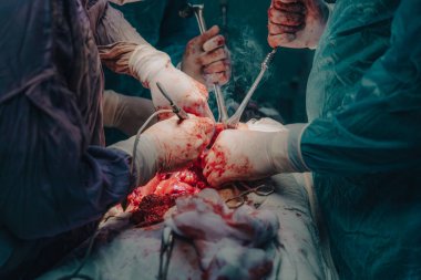 Bir grup cerrah bir hastaya ameliyat yapıyor. Olay yeri yoğun ve dramatik. Cerrahlar hastanın vücudunu kesmek için keskin aletler kullanıyor. Atmosfer ciddi.