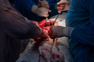 Bir grup cerrah bir hastaya ameliyat yapıyor. Cerrahlar hastanın hayatını kurtarmak için birlikte çalışırken sahne yoğun ve dramatik. Atmosfer ciddi ve odaklı.