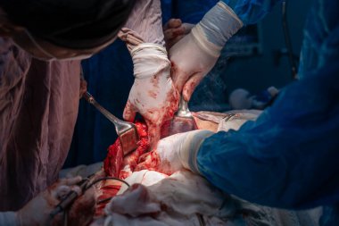 Bir grup cerrah bir hastaya ameliyat yapıyor. Cerrahlar görevlerine odaklandığı için sahne yoğun ve ciddi. Hasta çok acı çekiyor.