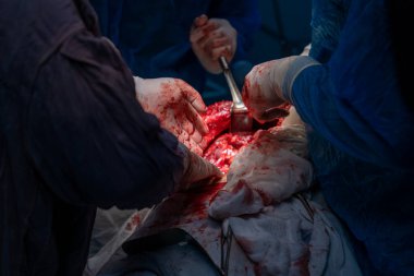 Bir grup cerrah bir hastaya ameliyat yapıyor. Cerrahlar hastanın hayatını kurtarmak için birlikte çalışırken sahne yoğun ve dramatik.