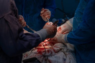 Bir grup cerrah bir hastaya ameliyat yapıyor. Cerrahlar görevlerine odaklandığı için sahne yoğun ve ciddi. Hastanın durumu kritik.