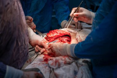 Bir grup cerrah bir hastaya ameliyat yapıyor. Cerrahlar hastanın vücudunu kesmek için keskin aletler kullandıkları için sahne yoğun ve dramatik. Atmosfer ciddi.